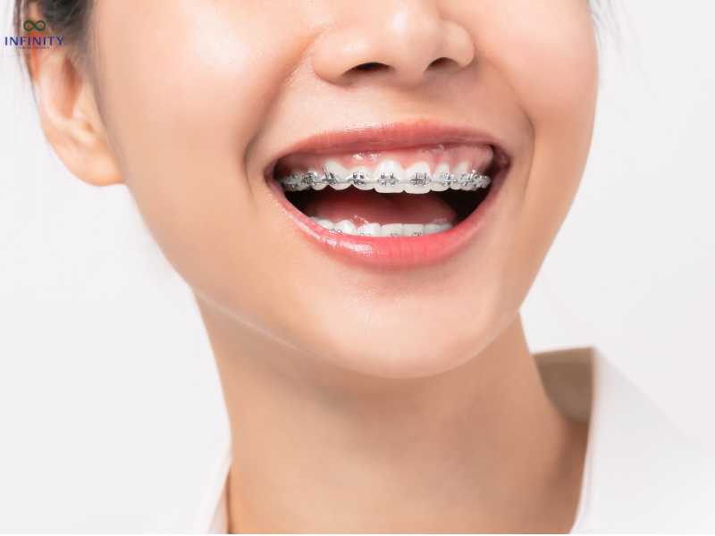 Niềng Răng Khớp Cắn Đối Đầu: Phương Pháp Điều Trị Hiệu Quả