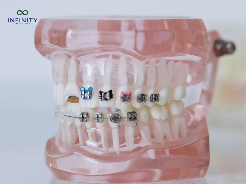 Trường hợp có thể niềng răng
