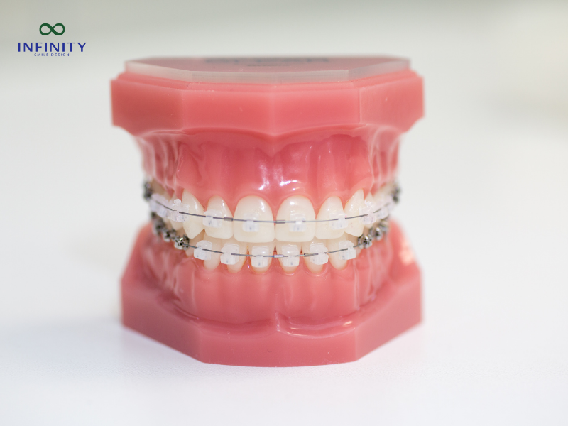 Mất răng số 7 có niềng răng được không?