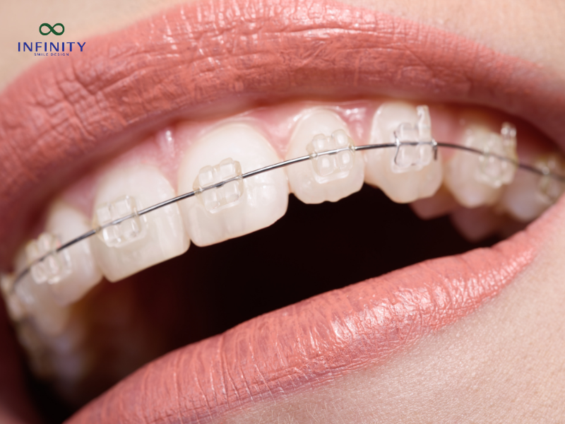 Niềng răng mắc cài sứ