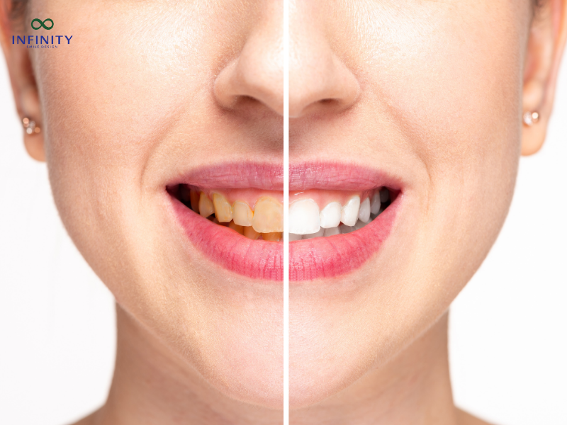 Câu hỏi thường gặp về độ tuổi làm răng sứ Câu hỏi thường gặp về độ tuổi làm răng sứ