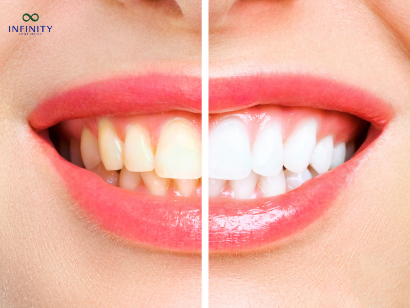 Các trường hợp răng nhiễm màu thường được chỉ định bọc răng sứ