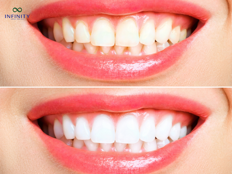 Ưu điểm và hạn chế của phục hình răng sứ