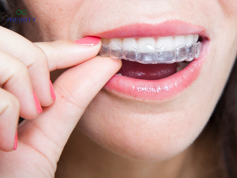 Quy trình niềng răng invisalign chuẩn y khoa Quy trình niềng răng invisalign chuẩn y khoa