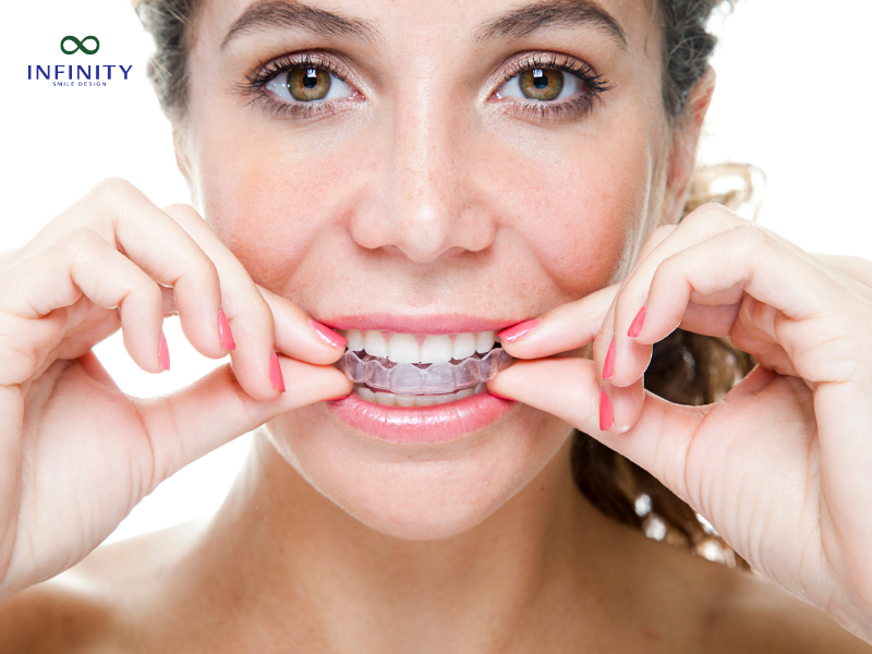 Niềng răng trong suốt (Invisalign)