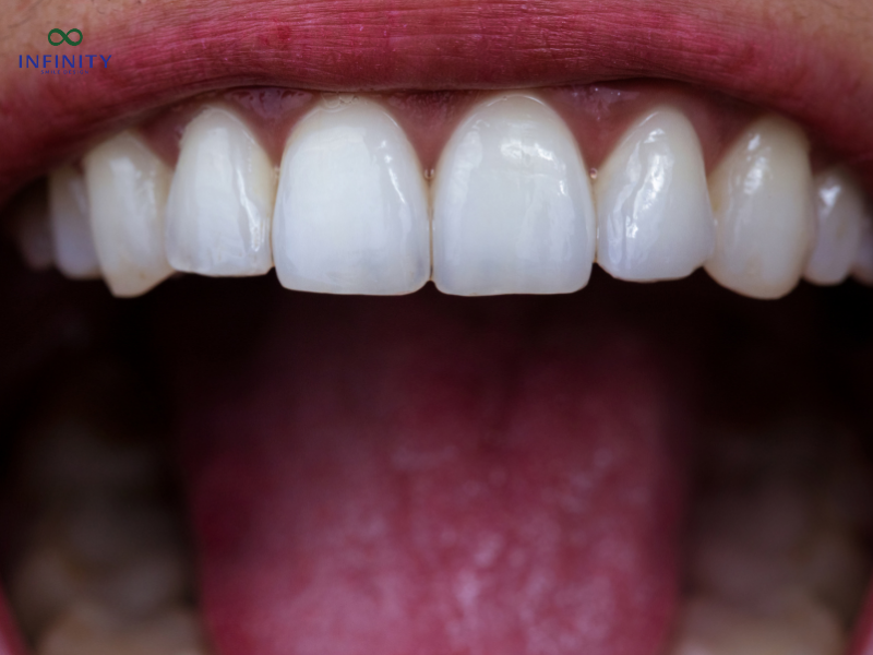 Lưu ý khi bọc răng sứ để tiết kiệm chi phí
