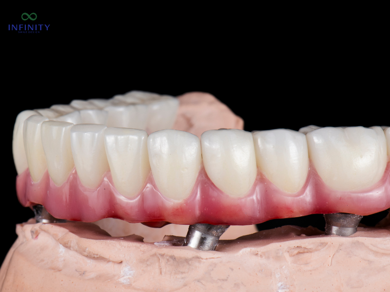 Ưu điểm vượt trội của phương pháp cấy ghép implant
