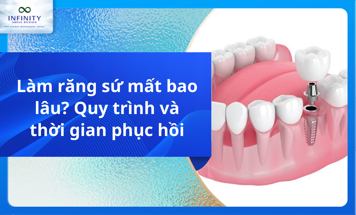 Làm răng sứ mất bao lâu? Quy trình và thời gian phục hồi