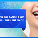 HÔ HÀM VÀ HÔ RĂNG LÀ GÌ? KHÁC NHAU NHƯ THẾ NÀO?