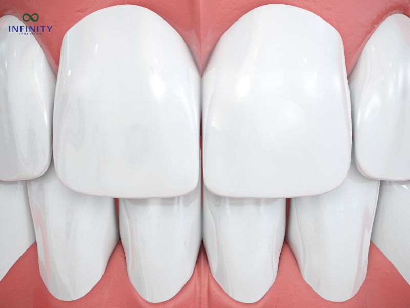 Một số điều lưu ý quan trọng khi làm răng sứ Một số điều lưu ý quan trọng khi làm răng sứ