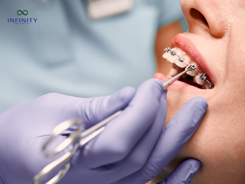 Các giai đoạn trong quy trình niềng răng