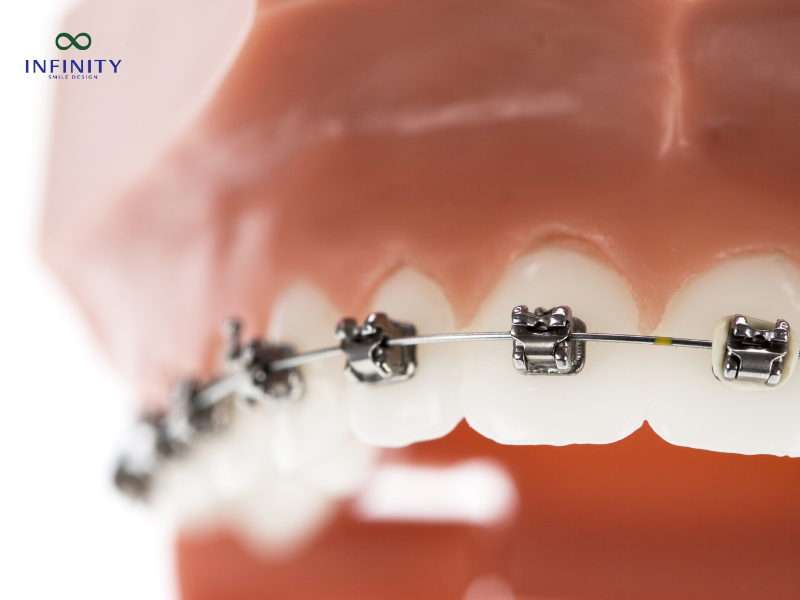Các phương pháp niềng răng khớp cắn hở hiệu quả nhất