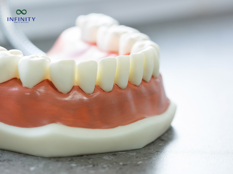 Chi phí niềng răng hô nhẹ - Niềng răng hô nhẹ bao nhiêu tiền?
