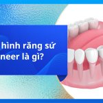 PHỤC HÌNH RĂNG SỨ VENEER LÀ GÌ?