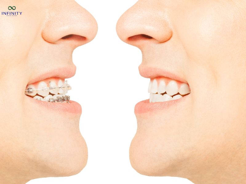 CÁC TRƯỜNG HỢP CẦN KÉO RĂNG CHỈNH NHA 3 Chuẩn bị cho các điều trị khác