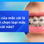 Vai trò của mắc cài là gì? Nên chọn loại mắc cài nào?
