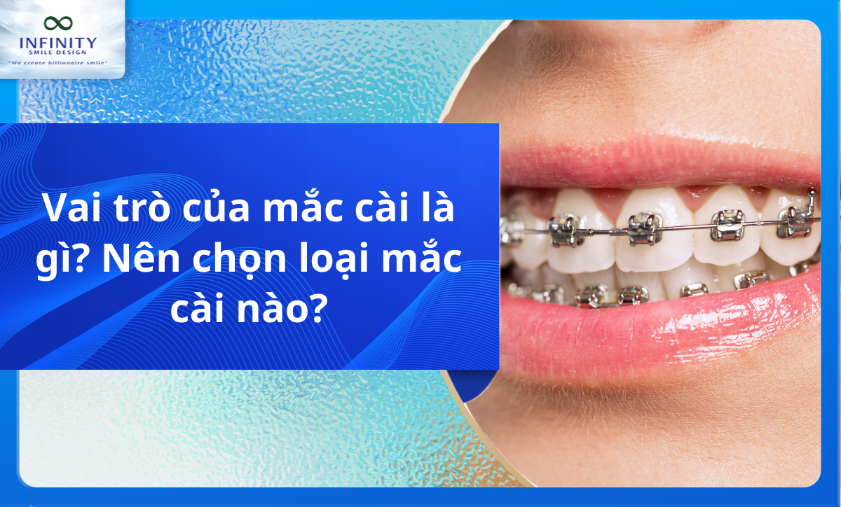 Vai trò của mắc cài là gì? Nên chọn loại mắc cài nào?