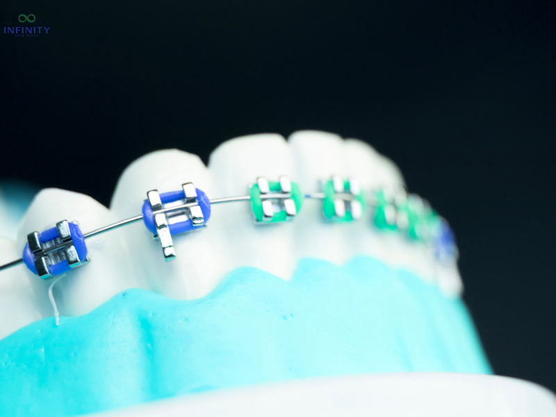 Niềng răng 1 hàm là phương pháp chỉnh nha chỉ tác động lên một hàm