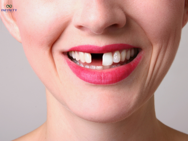 Một số biến chứng muộn của điều trị implant Một số biến chứng muộn của điều trị implant