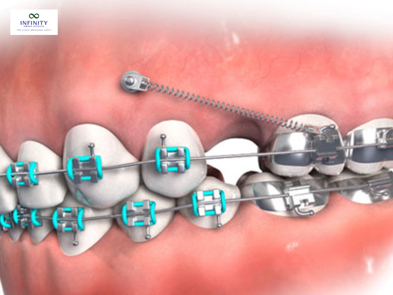 cắm vít niềng răng bị sưng