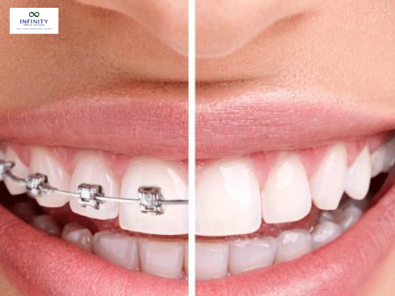 Việc di chuyển một răng thường cần dựa vào lực kéo từ các răng khác