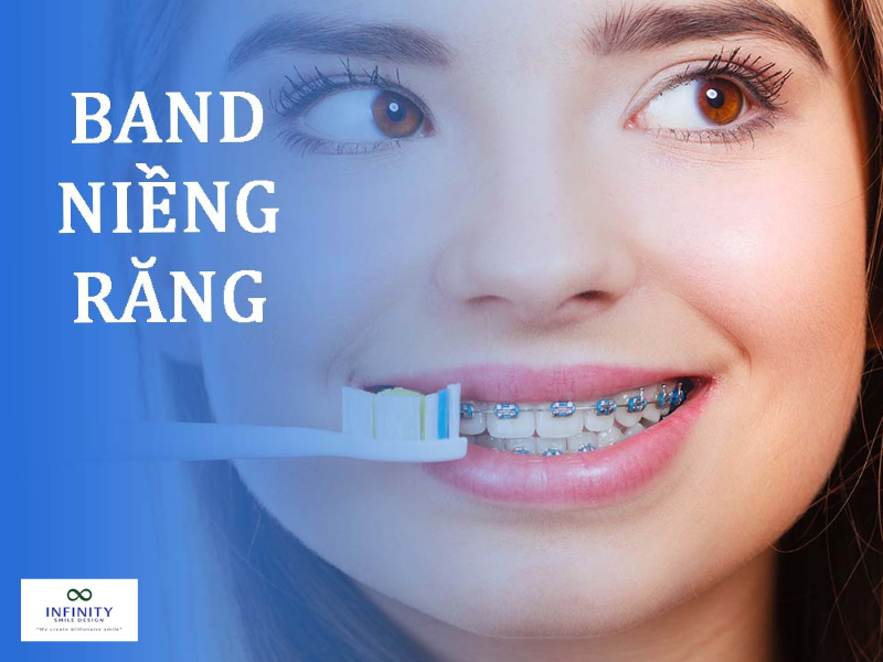 Chuẩn bị cho giai đoạn gắn band niềng răng