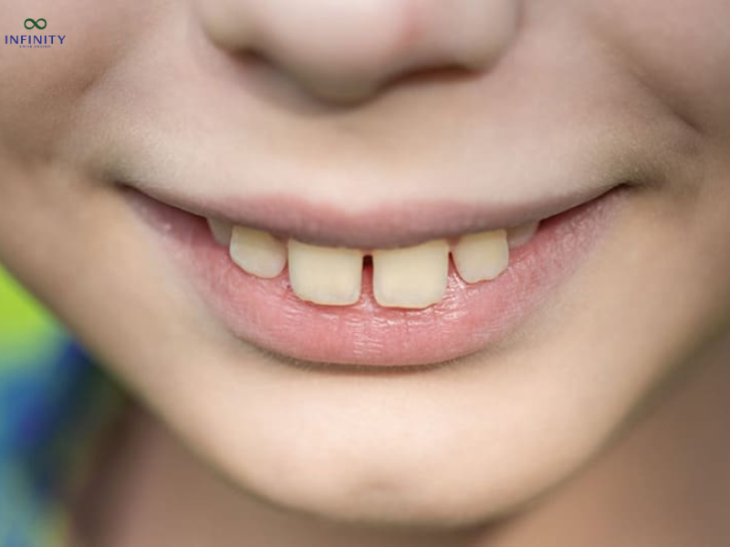 Răng hô (hay hàm hô) là một dạng sai lệch khớp cắn thường gặp