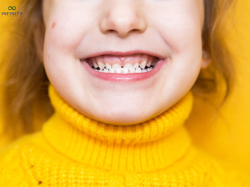 Thời gian điều trị răng móm nhẹ 