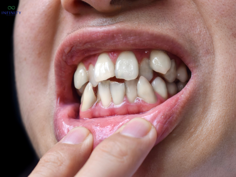 Răng nanh mọc ngầm là gì?