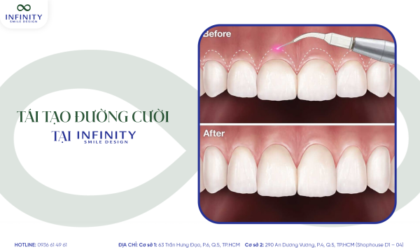 1. tái tạo dg cừoi