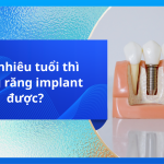 Bao nhiêu tuổi thì trồng răng implant được?