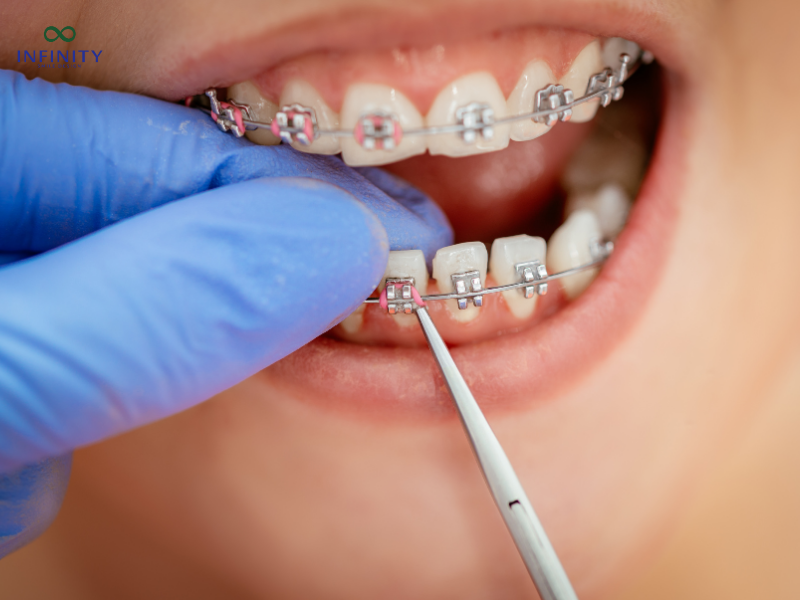Tận dụng tối ưu giai đoạn phát triển xương hàm