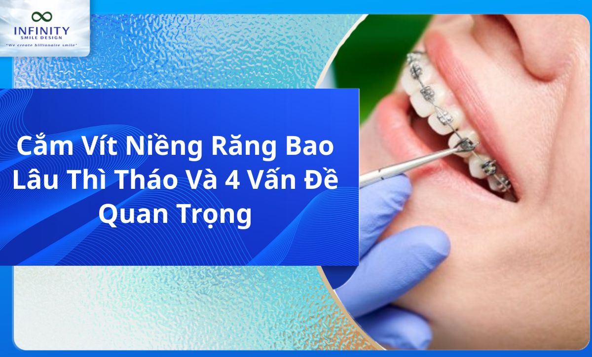 Cắm Vít Niềng Răng Bao Lâu Thì Tháo Và 4 Vấn Đề Quan Trọng