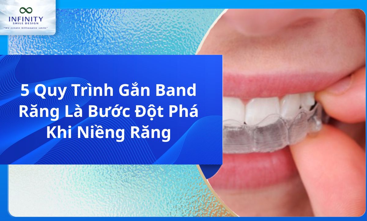 5 Quy Trình Gắn Band Răng Là Bước Đột Phá Khi Niềng Răng