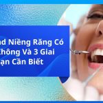 Gắn Band Niềng Răng Có Đau Không Và 3 Giai Đoạn Cần Biết