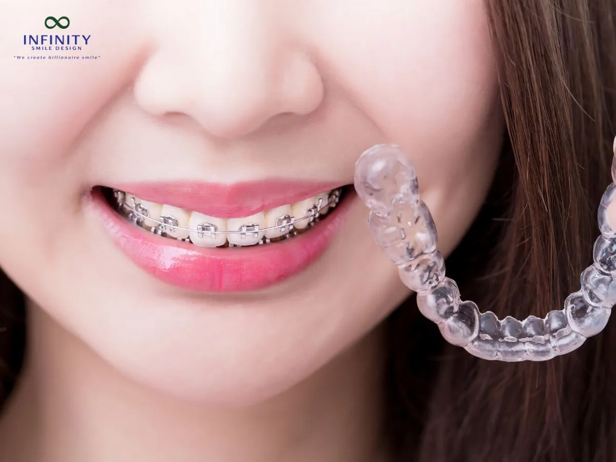 Nguyên nhân khiến dây thun niềng răng bị vàng