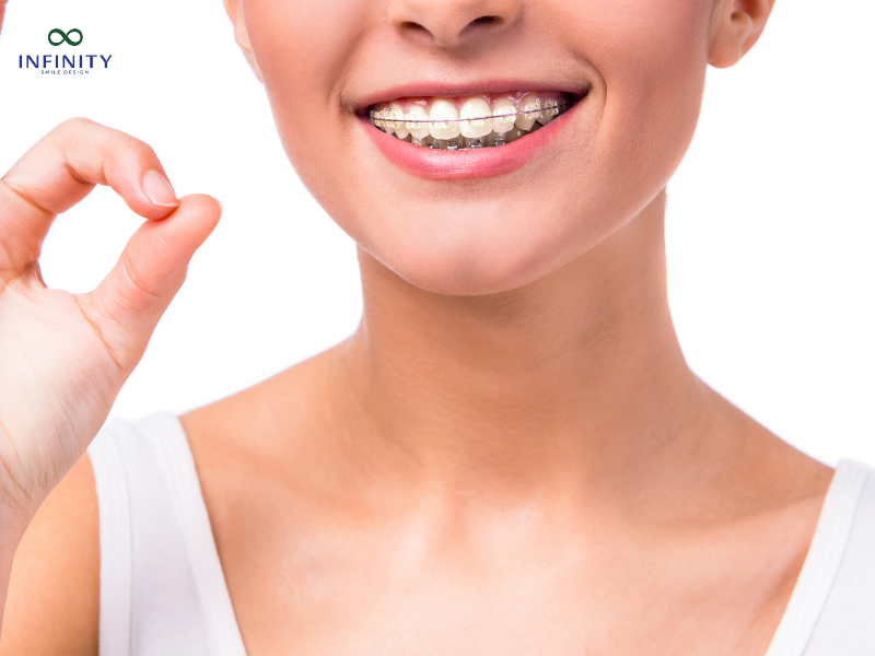 Niềng Răng Bằng Mắc Cài Sứ Niềng Răng Bằng Mắc Cài Sứ