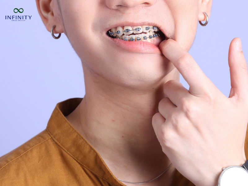 Hậu Quả Khi Mất Răng Số 5