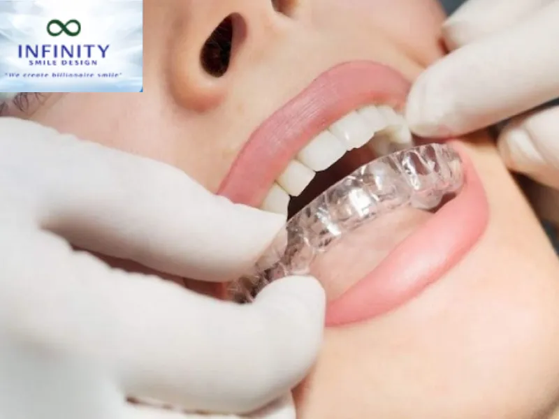 Niềng Răng Bằng Nhựa: Lựa Chọn Cho Nụ Cười Hoàn Hảo 3 Niềng răng bằng nhựa sử dụng các khay trong suốt, gần như vô hình khi đeo.