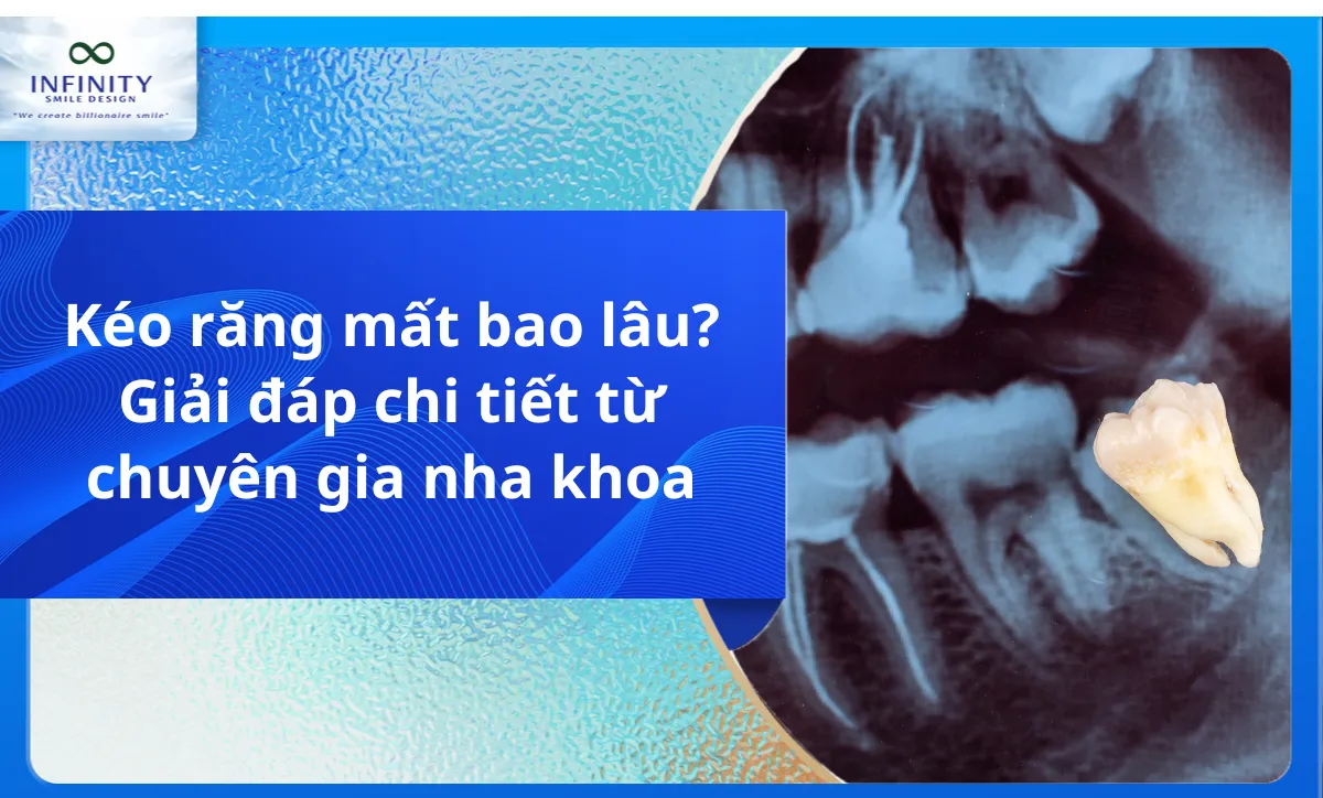 Kéo răng mất bao lâu? Giải đáp chi tiết từ chuyên gia nha khoa