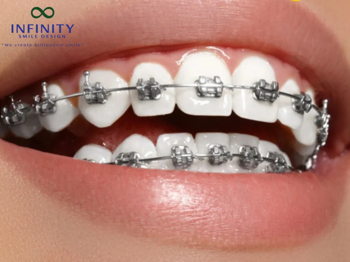 Bệnh nhân cần chú ý chăm sóc và vệ sinh răng miệng kỹ càng, dùng chỉ nha khoa, nước súc miệng theo hướng dẫn của bác sĩ.