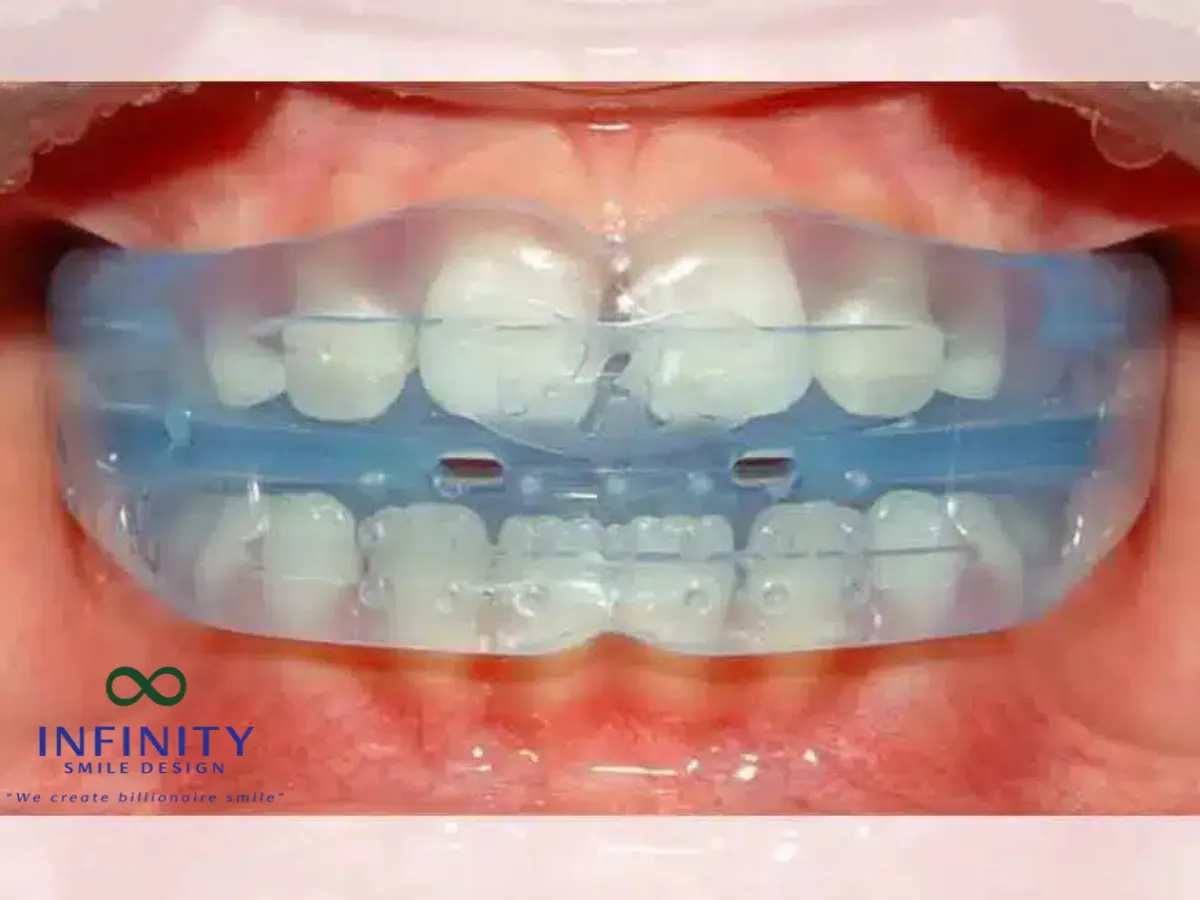 Bạn cần đeo khay niềng mỗi ngày khoảng 20-22 tiếng và thay khay mới theo lịch trình đã được thiết kế sẵn (thường là 1-2 tuần một lần). Mỗi khay niềng sẽ di chuyển răng một chút để đạt hiệu quả dịch chuyển theo kế hoạch