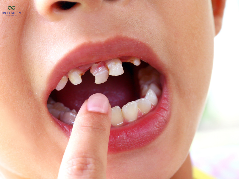 MẤT RĂNG CÓ NIỀNG RĂNG ĐƯỢC KHÔNG? 2 Vị trí răng bị mất