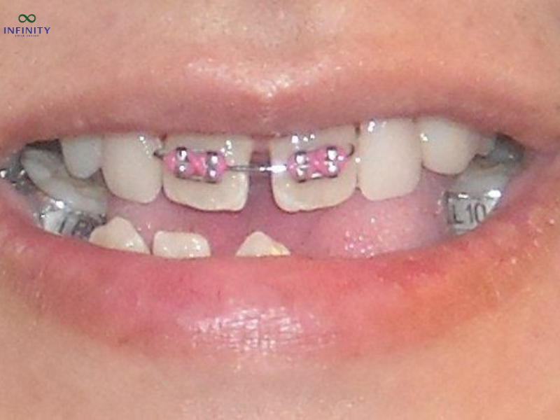 Mất Răng Số 5 Có Niềng Được Không?