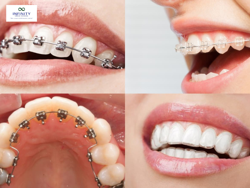 Thời điểm tháo vít phụ thuộc vào rất nhiều yếu tố cá nhân và tiến trình điều trị