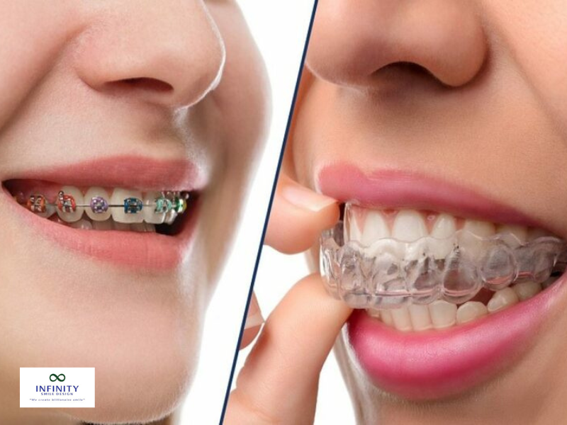Band niềng răng bao quanh toàn bộ thân răng, tạo ra một điểm tựa cực kỳ vững chắc