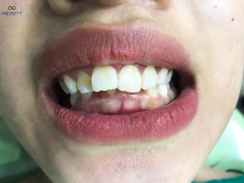 GIẢI ĐÁP NHỮNG THẮC MẮC PHỔ BIẾN VỀ NIỀNG RĂNG HÔ 2 Hô hỗn hợp là một trong các dạng hô răng thường gặp
