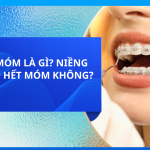 RĂNG MÓM LÀ GÌ? NIỀNG RĂNG CÓ HẾT MÓM KHÔNG? 