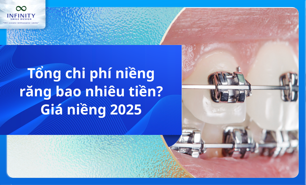 Tổng chi phí niềng răng bao nhiêu tiền? Giá niềng 2025