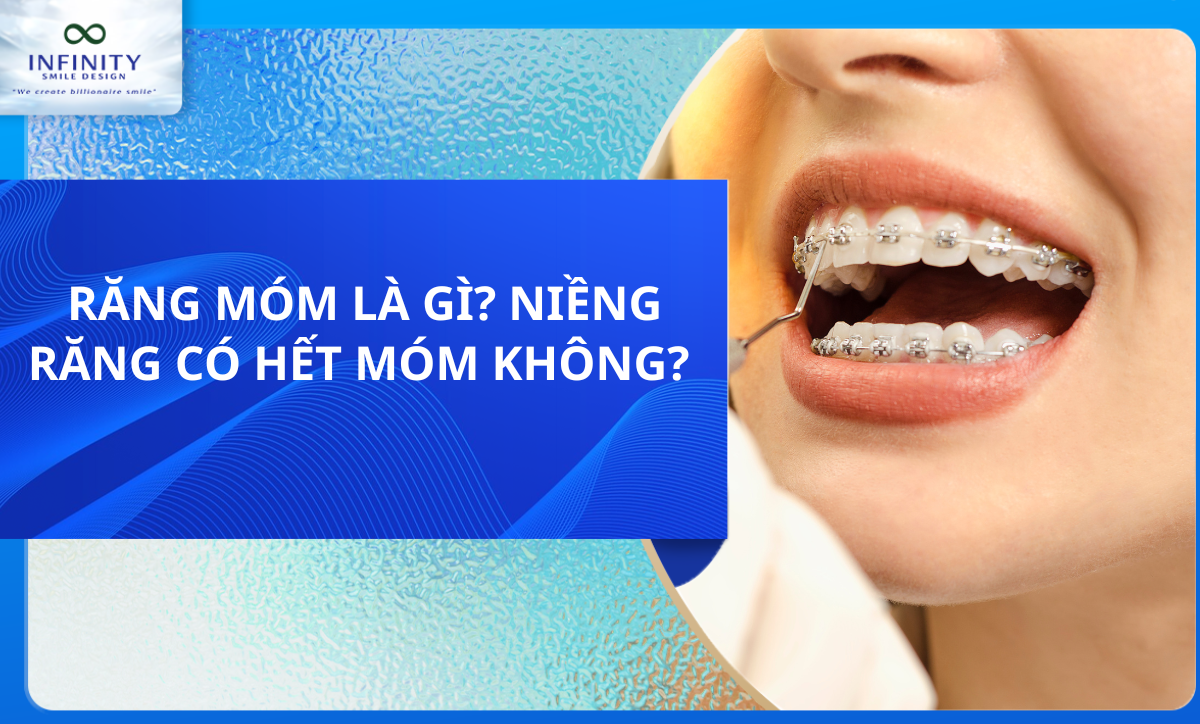 RĂNG MÓM LÀ GÌ? NIỀNG RĂNG CÓ HẾT MÓM KHÔNG? 